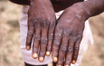 MOH Reports 2 New Mpox Cases, Infections Rising to 33