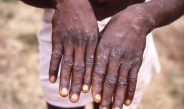 Ministry of Health Confirms New Mpox Case, Total Infections Now at 18