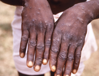 Ministry of Health Confirms New Mpox Case, Total Infections Now at 18