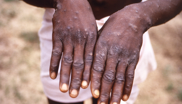 Ministry of Health Confirms New Mpox Case, Total Infections Now at 18